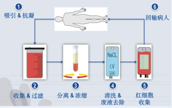 自体血回收机的临床应用与护理配合